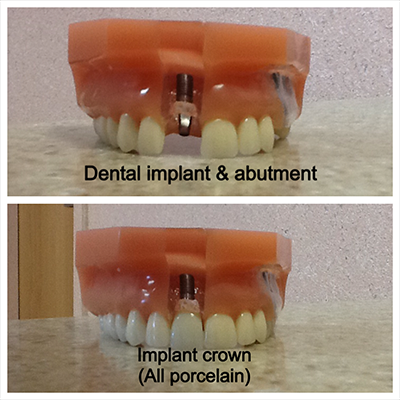 Tooth Replacement