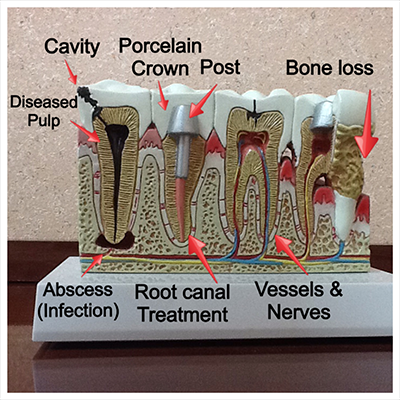 Root Canal